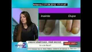 Tratamentul Onicomicozei Micoza Unghiei cu LaserulFormatk  Traieste sanatos Antena 2 [upl. by Kizzee]