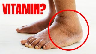 1 Vitamin to Eliminate Swelling in Feet and Legs [upl. by Horan]