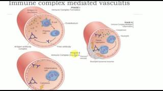 MEDICINE LECTURES  VASCULITIS  Part 1 [upl. by Ayhtak]