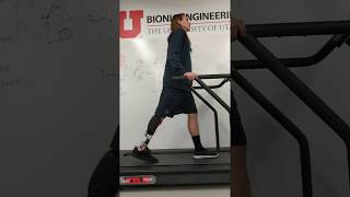 Utah Bionic Leg  Walking 1 ms  Aboveknee Amputee [upl. by Pfister]