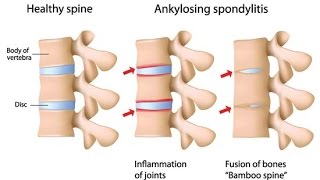 Ankylosing Spondylitis [upl. by Llerdnad214]