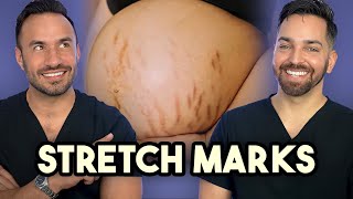 Major Announcement  How to Treat Stretch Marks like a Dermatologist [upl. by Assenar]