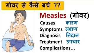 Measles  Causes Symptoms Treatment Vaccination  Rubella vs Rubeola  Red measles [upl. by Rednaxela342]