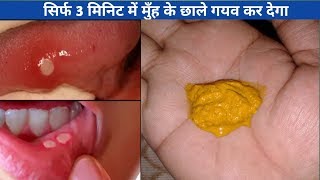 3 मिनिट मे मुंह और जीभ के छाले ठीक करने के लिए घरेलु उपाय  How To Get Rid Of Mouth and Tongue Ulcer [upl. by Arbas]