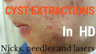 Cysts extractions blackheads  Removal methods in HD [upl. by Reppep]