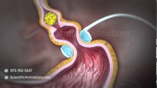 Gastric Band Animation  Digestive System Animation [upl. by Jenna]