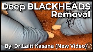 Deep Old Blackhead Removal with Cotton Buds amp Extractor by DrLalit Kasana [upl. by Patterman]