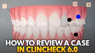 How to Review an Invisalign Case in Clincheck 60 [upl. by Luas212]