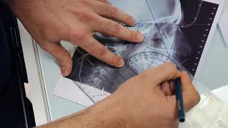 Tracing a cephalometric xray for patient has anterior open bite malocclusion [upl. by Tiphani]