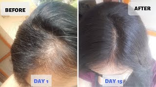 OMG  15 Days Hair Growth Miracle Treatment  Grow Long Thicken Hair  100 works [upl. by Marx]