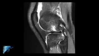 How to Read Knee MRI of ACL Tear  Anterior Cruciate Ligament Pain  Knee Surgery  Minneapolis MN [upl. by Bremer]