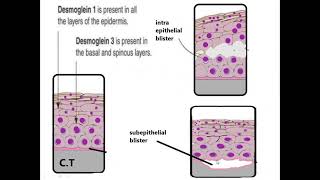 periodontal lecture topic DESQUAMATIVE GINGIVITIS in Hindi [upl. by Aillil]