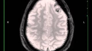 Meningioma left frontal [upl. by Banyaz]