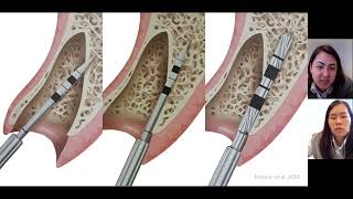 Posicionamento tridimensional de implantes em região estética como definir o perfil de emergência [upl. by Aneetsyrk]