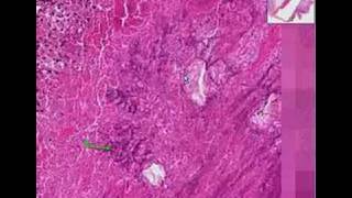 Histopathology Heart aortic valve Bacterial endocarditis [upl. by Naoh927]