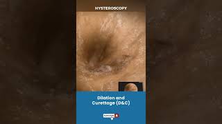 बच्चेदानी Uterus का Dilation और Curettage  Procedure for removing unwanted tissue in uterus [upl. by Nnaillek]