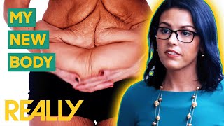 Shedding 10lbs Of Excess Skin After 192lb Weight Loss  My Extreme Excess Skin [upl. by Adnolay300]