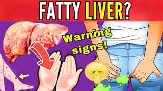 8 SIGNS THAT INDICATE LIVER FAT  EARLY SYMPTOMS OF HEPATIC STEATOSIS silent threat [upl. by Dionne15]