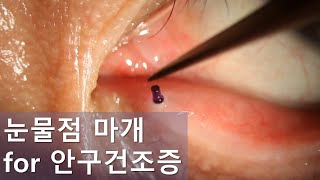 눈물점 마개 시술 안구건조증 치료 Punctal plugs insertion for dry eyes [upl. by Llednor]