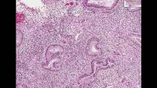 Histopathology Uterus endometriumSecretory endometrium [upl. by Irahs]