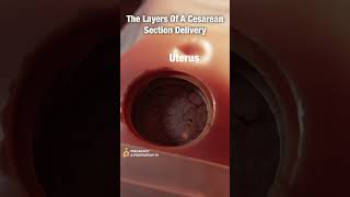 Layers of CSection Delivery ✨FASCINATING✨ shorts [upl. by Hallutama]