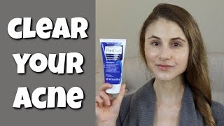 HOW TO CLEAR YOUR SKIN WITH BENZOYL PEROXIDE DR DRAY [upl. by Kuska558]