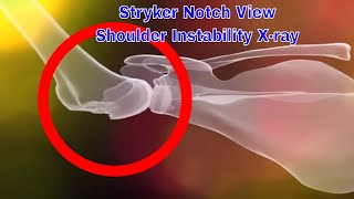 Stryker Notch view  Shoulder Instability Xray 어깨 불안정을 검사하는 Xray [upl. by Glenn]