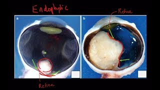 High Yield Topic Retinoblastoma  A Complete Review [upl. by Jak]