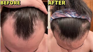 HYPERRESPONDER ON BIG 3  MICRONEEDLING HAIR LOSS STACK INSANE 5 MONTH RESULTS [upl. by Eimile]