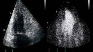 CONTRAST ECHO CARDIOMYOPATHIE TRABECULATION OU NON [upl. by Ulrika]