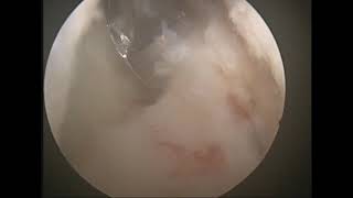 Enblock Removal of Ligamentum Flavum with Uniportal Full Endoscopy SD 480p [upl. by Tsai]