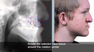 Treatment planning and soft tissue prediction 9 with Facad software [upl. by Paske170]