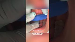 Dental veneer procedure  dental veneers step by step  dental veneers for gapped teeth  Dr Yazdan [upl. by Woodhouse570]