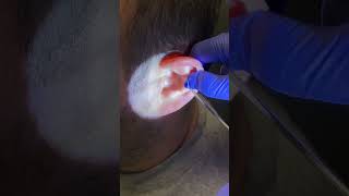 It looks so big under the microscope… earwaxremoval extractionsatisfaction earwax ears cerumen [upl. by Yevreh]