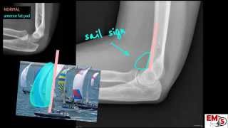 Elbow Xray Interpretation [upl. by Alahsal292]