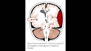 Herniation Syndromes  Cingulate subfalcine Transtentorial Uncal amp Cerebellar Tonsillar [upl. by Ahsotal]