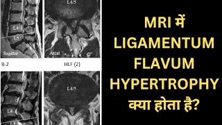 MRI में LIGAMENTUM FLAVUM HYPERTROPHY क्या होता है backpain spinehealth ligamentumflavum [upl. by Nagiem330]