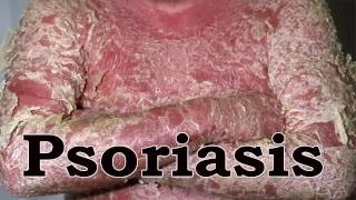 Home Remedies For Psoriasis  How To Treat Psoriasis Naturally [upl. by Suoicserp357]