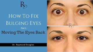 How To Fix Bulging Eyes  Part 1  Moving The Eyes Back [upl. by Hamid]