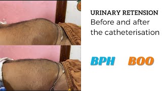 DISTENDED BLADDER  AFTER CATHETERISATION [upl. by Elyr]