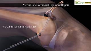 Knee Cap Surgery Hyderabad  Patella Dislocation Treatment  Patellofemoral Ligament Repair [upl. by Salman443]