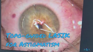 Contoura Vision Laser Eye Surgery for Astigmatism  Topographyguided LASIK PRK [upl. by Nigrom829]