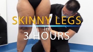 Lipo 360 Knees  Leg Liposuction  Immediate Results  Lipedema Surgery  Artlipo  Expert Dr Su [upl. by Kinzer]