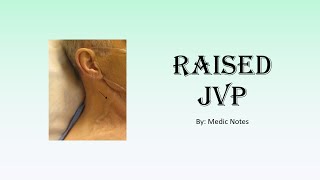 Raised JVP  definition causes pathophysiology sign value [upl. by Walden]