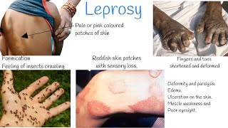 Leprosy signs and symptoms Treatment Hansens Disease [upl. by Ahsino371]