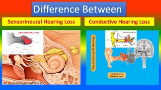 Difference between Sensorineural Hearing Loss and Conductive Hearing Loss [upl. by Fanchie]