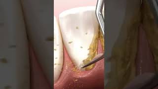 deep teeth cleaning shorts scaling and root planing procedure [upl. by Mchenry92]