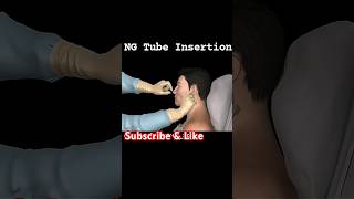 ng tube insertion procedure  ng tube foryou shorts [upl. by Nordine589]