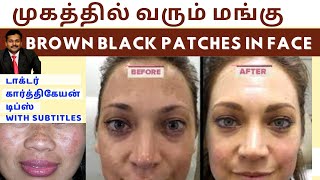 மங்கு மறைய டிப்ஸ்Home remedies to remove brown black patches spots hyperpigmentation on face skin [upl. by Milka]