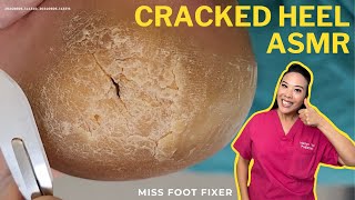 Exploring the Mythology of the Creaked Heel ASMR  Miss Foot Fixer [upl. by Naesal]